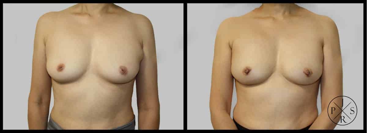 Inverted Nipple Correction Before & After Image