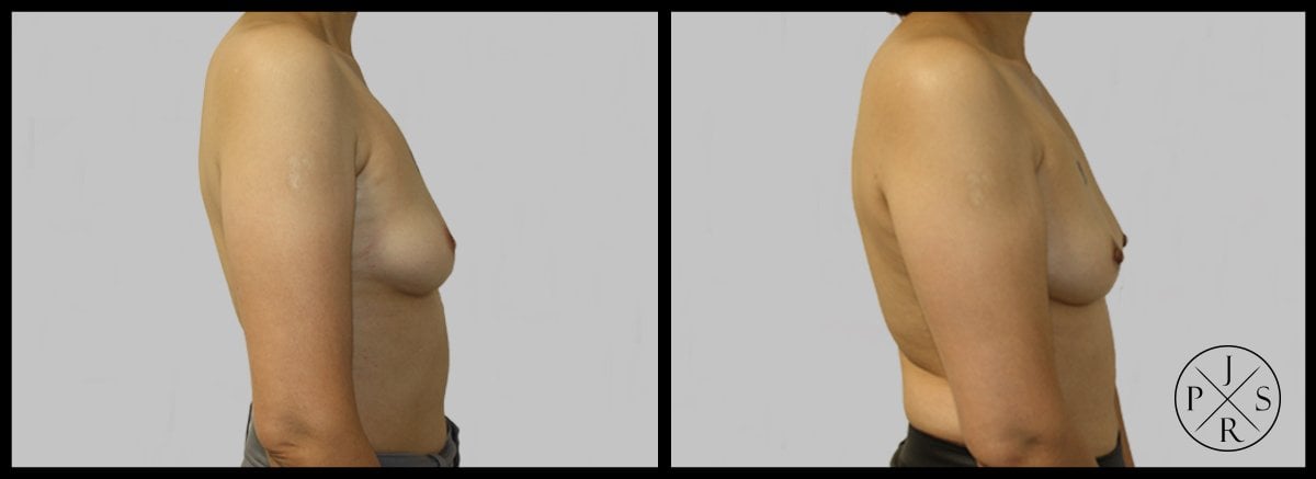 Inverted Nipple Correction Before & After Image