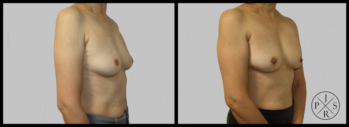 Inverted Nipple Correction Before & After Image