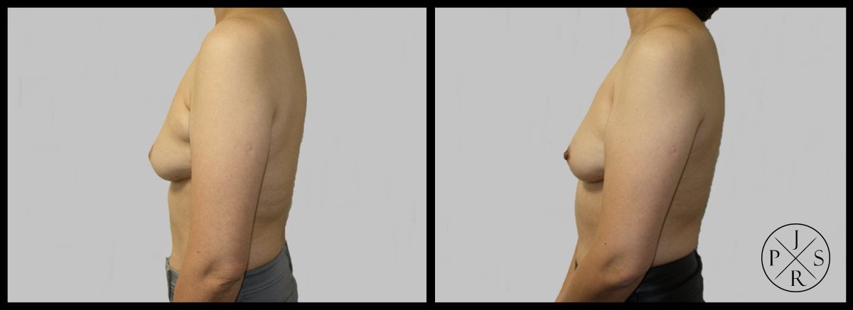 Inverted Nipple Correction Before & After Image