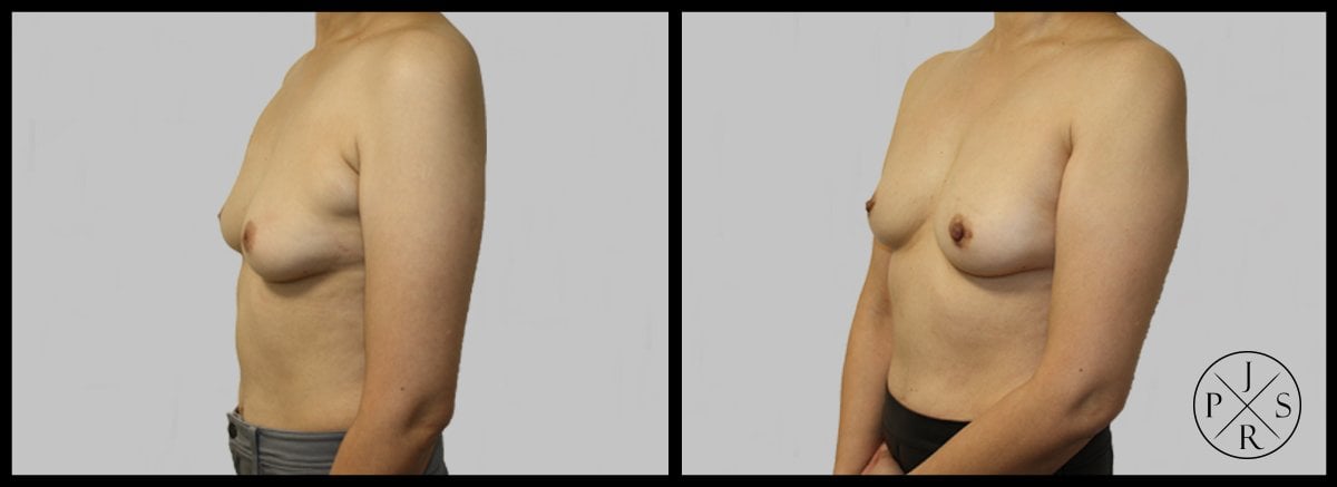 Inverted Nipple Correction Before & After Image