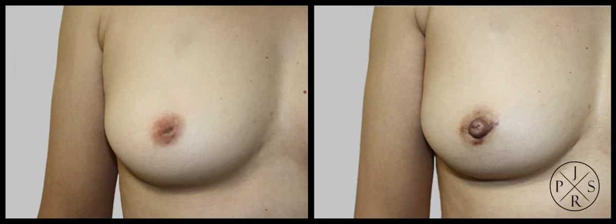 Inverted Nipple Correction Before & After Image