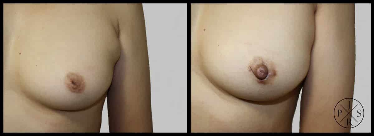 Inverted Nipple Correction Before & After Image