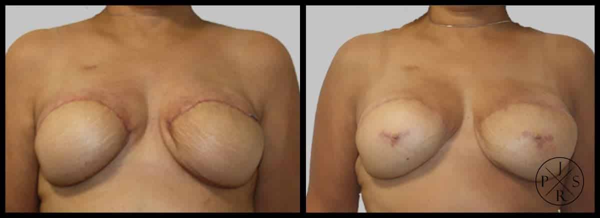 Areola Reconstruction Before & After Image