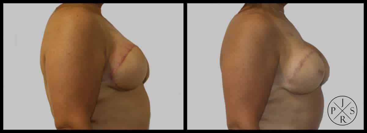 Areola Reconstruction Before & After Image