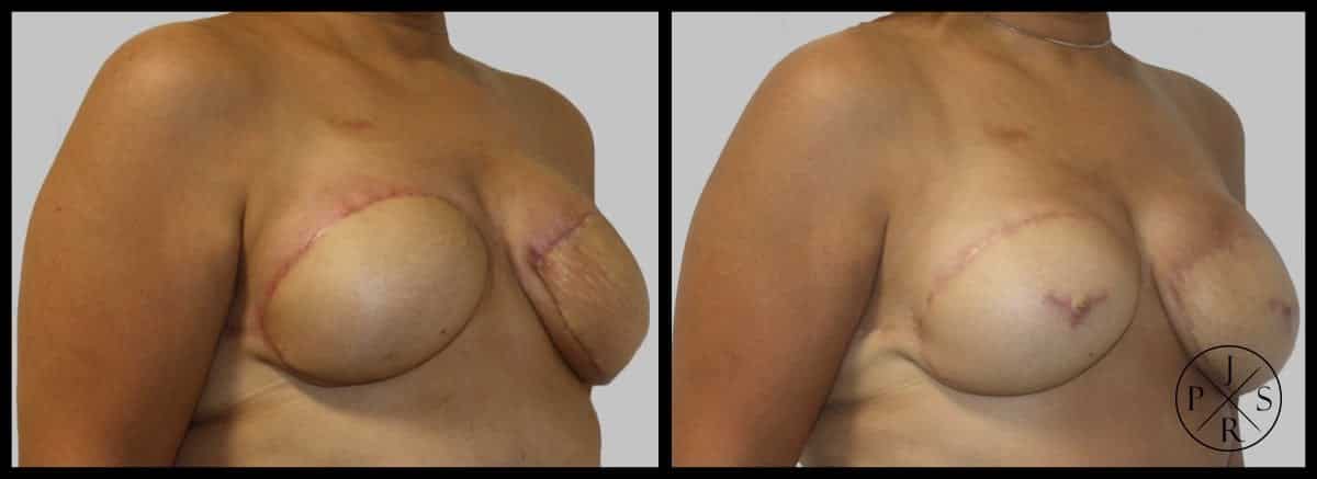 Areola Reconstruction Before & After Image