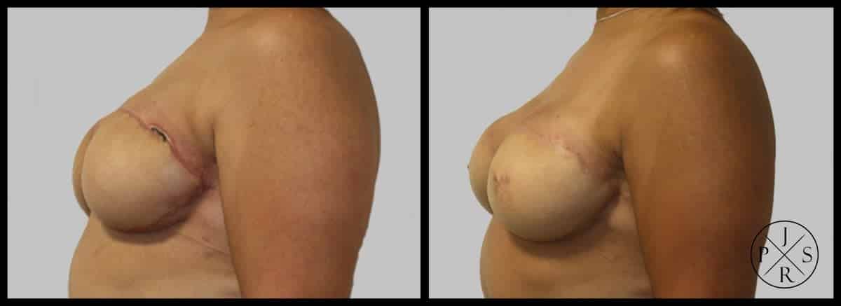 Areola Reconstruction Before & After Image