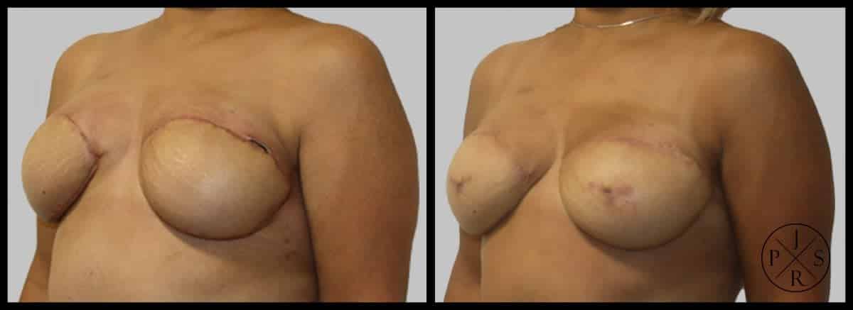 Areola Reconstruction Before & After Image