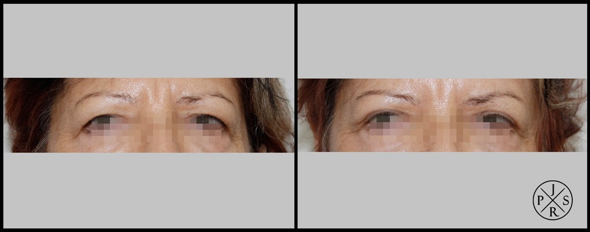 Blepharoplasty Before & After Image