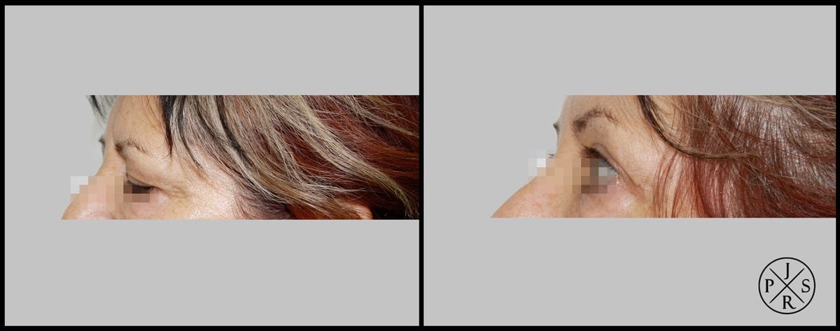 Blepharoplasty Before & After Image