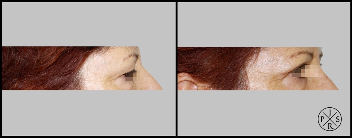 Blepharoplasty Before & After Image