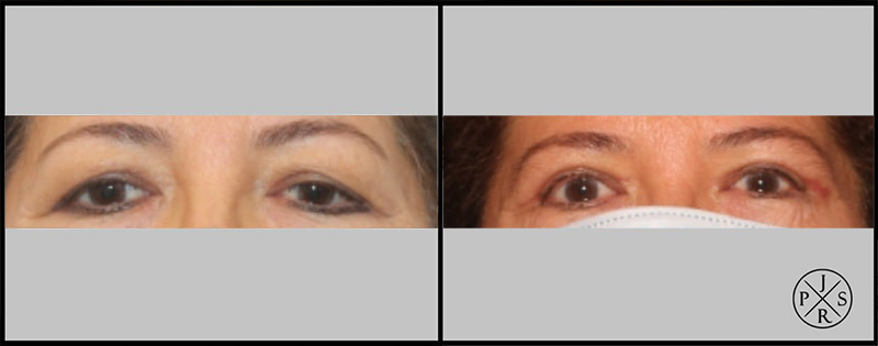 Blepharoplasty Before & After Image