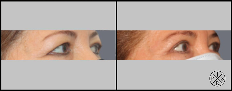 Blepharoplasty Before & After Image