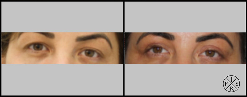 Blepharoplasty Before & After Image