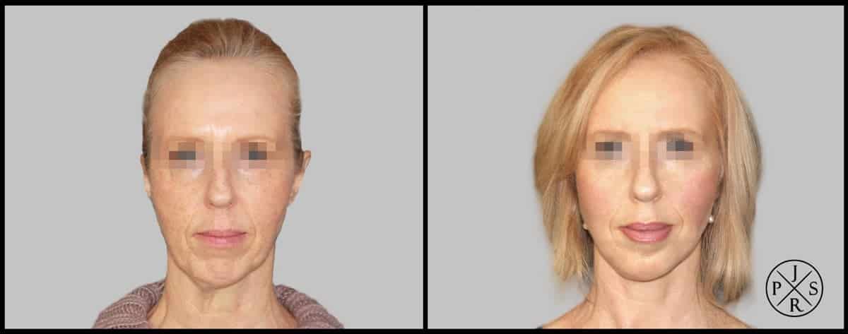 Facelift Before & After Image