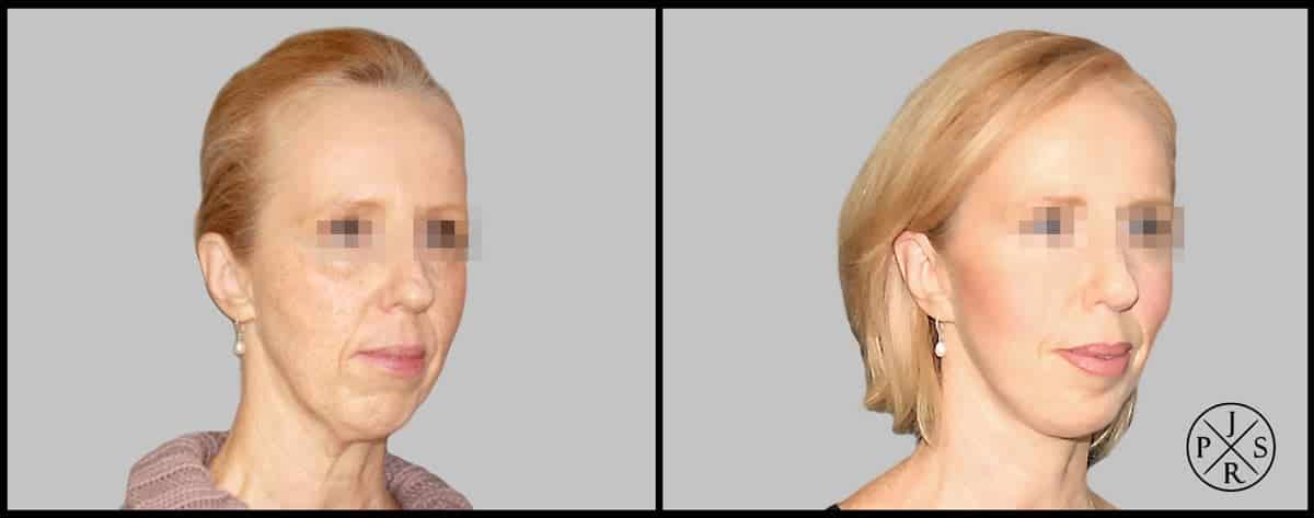 Facelift Before & After Image