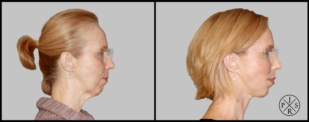 Facelift Before & After Image