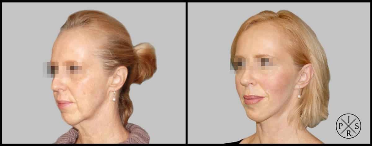 Facelift Before & After Image