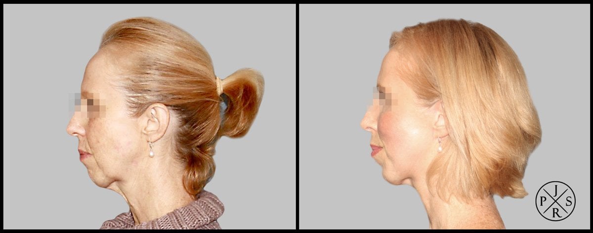 Facelift Before & After Image