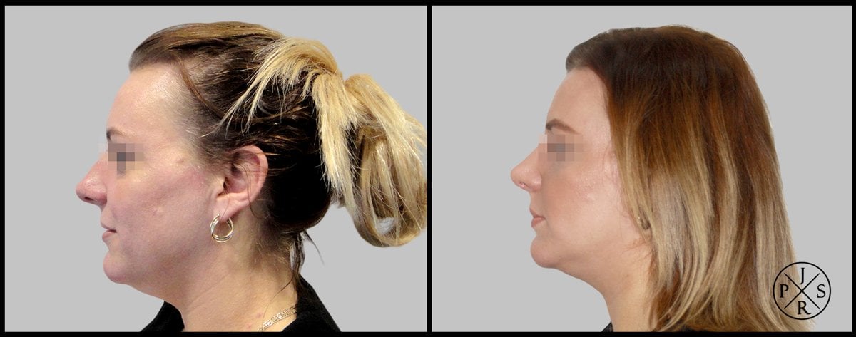 Rhinoplasty Before & After Image