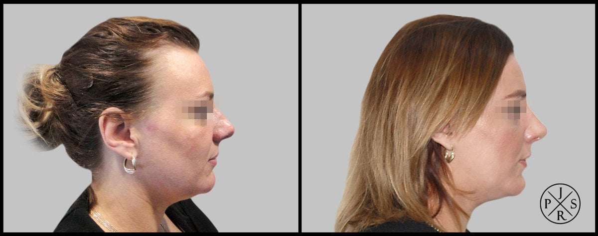 Rhinoplasty Before & After Image