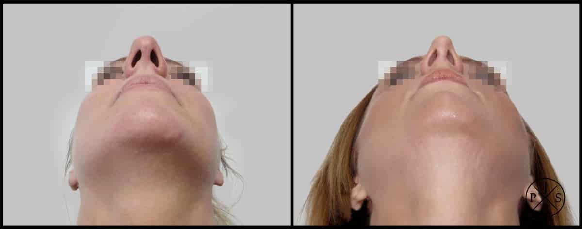 Rhinoplasty Before & After Image