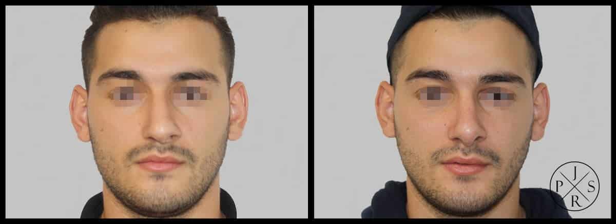 Rhinoplasty Before & After Image