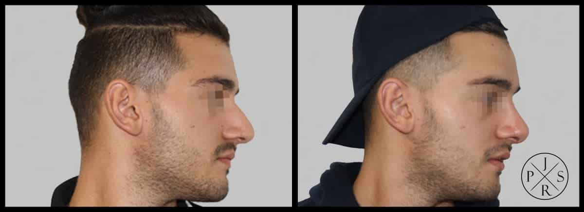 Rhinoplasty Before & After Image