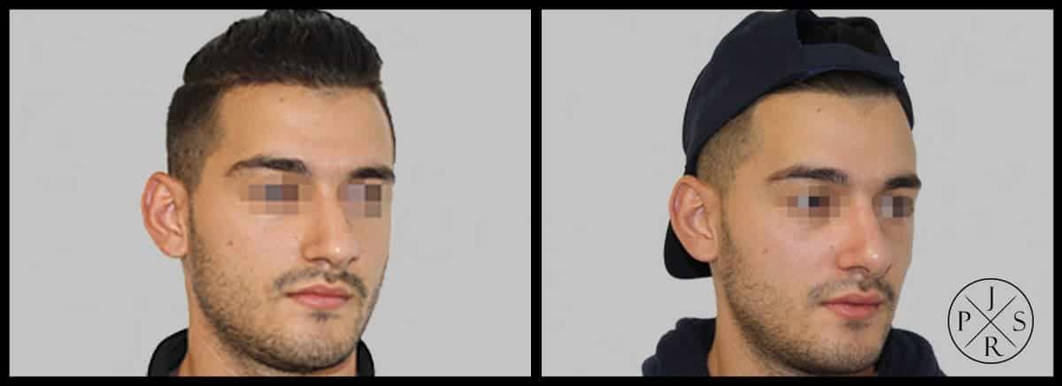 Rhinoplasty Before & After Image