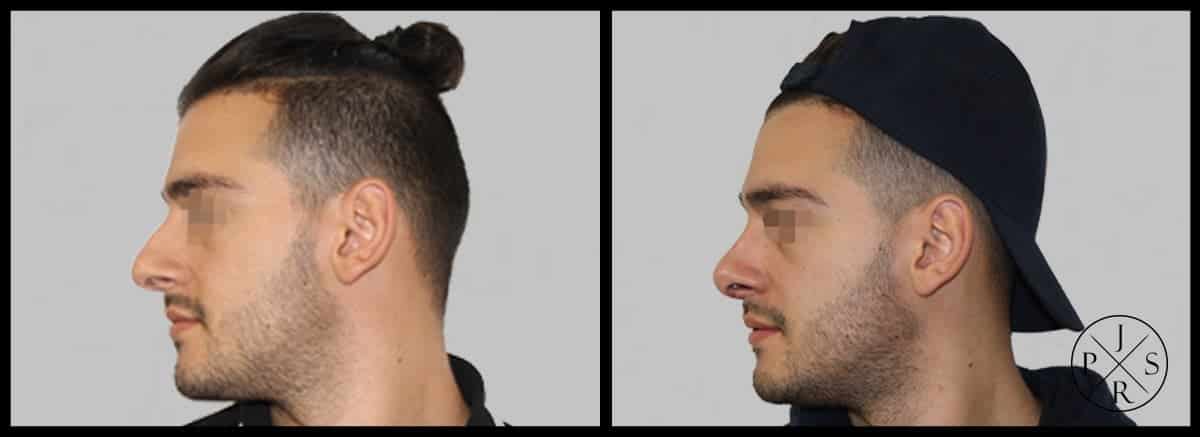 Rhinoplasty Before & After Image