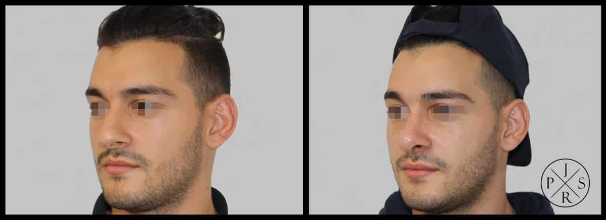 Rhinoplasty Before & After Image