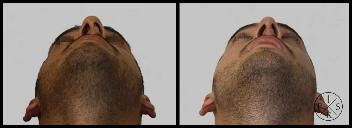 Rhinoplasty Before & After Image