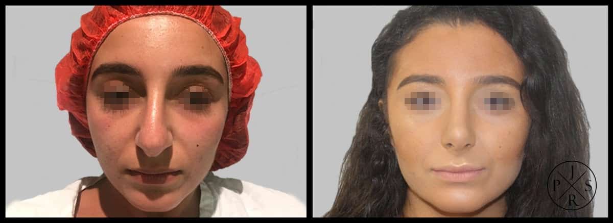 Rhinoplasty Before & After Image