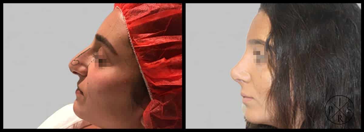 Rhinoplasty Before & After Image