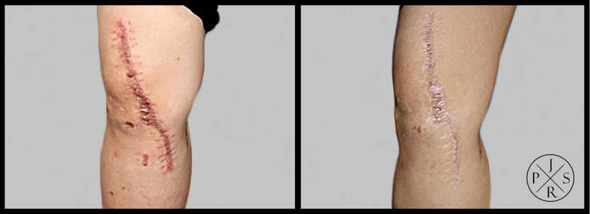 Fractional Laser Before & After Image