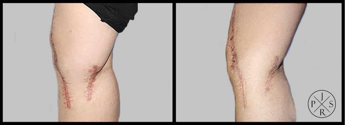 Fractional Laser Before & After Image