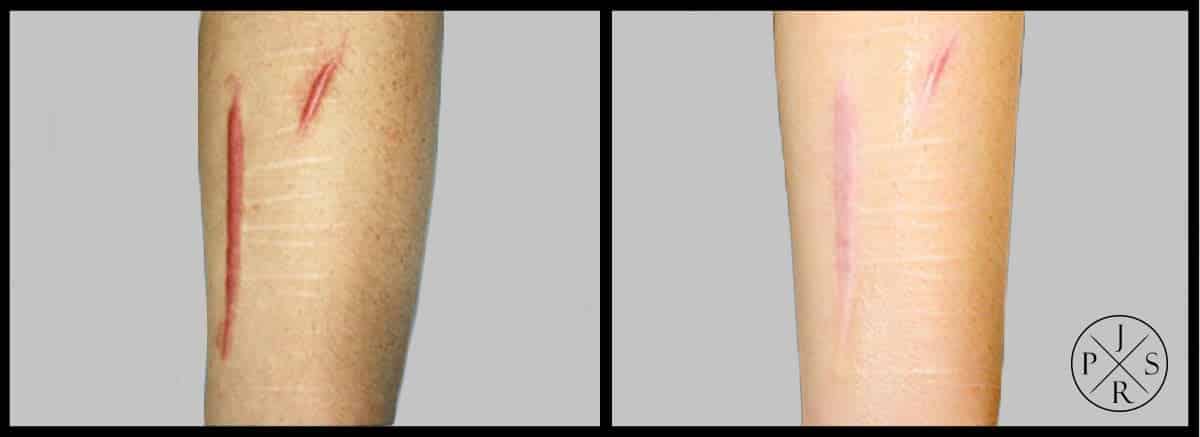 Fractional Laser Before & After Image