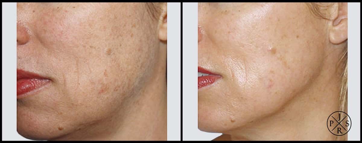 Fractional Laser Before & After Image