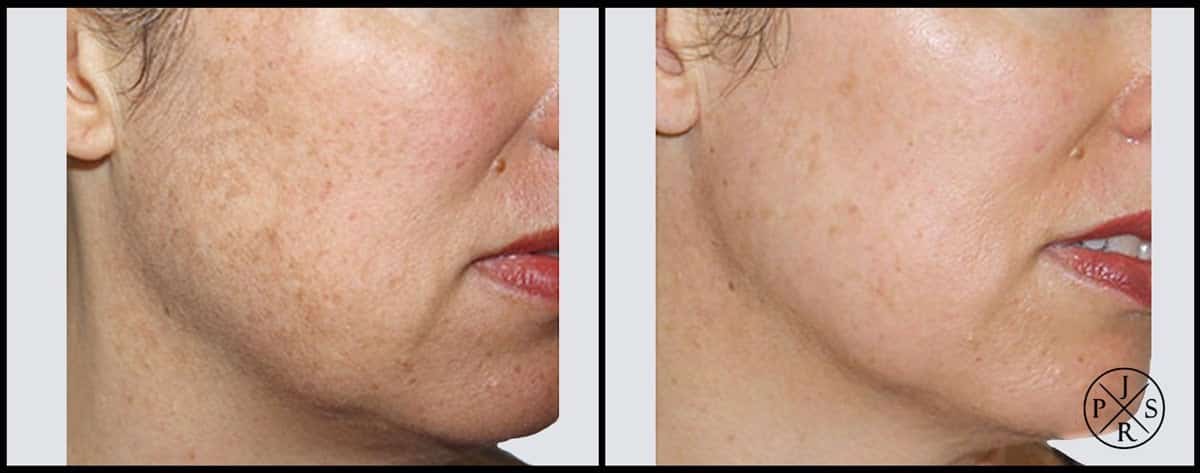 Fractional Laser Before & After Image